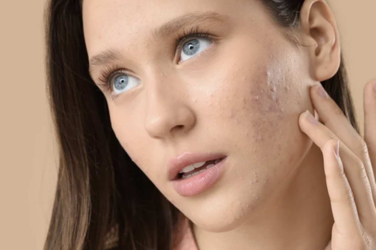 Questo gesto istintivo può portare a conseguenze spiacevoli, come segni e cicatrici difficili da rimuovere.